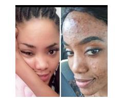 BUY 3D SKIN LIGHTENING/WHITENING PRODUCTS( NO SIDE EFFECTS ) +27717813089 BLOEMFONTEIN, WITBANK