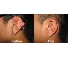 KELOID SCAR REMOVAL - MORINGA HERBAL OIL +27717813089 Randburg, Roodepoort, Pretoria