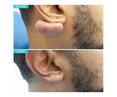 KELOIDS SCAR & WARTS REMOVAL PRODUCTS +27736847115 GUINEA BISSAU