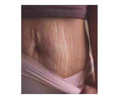 DR MICHELLE OFFERS PERMANENT STRETCH MARKS REMOVAL CREAM +27717813089 BEDFORDVIEW, MODDERFONTEIN